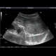 Focal nodular hyperplasia, CEUS: US - Ultrasound