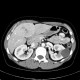 Focal nodular hyperplasia, FNH, flow rate of contrast: CT - Computed tomography
