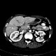 Focal nodular hyperplasia, FNH, flow rate of contrast: CT - Computed tomography