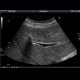 Focal nodular hyperplasia (FNH), CEUS: US - Ultrasound