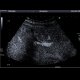 Focal nodular hyperplasia (FNH), CEUS: US - Ultrasound