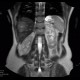 Focal nodular hyperplasia, liver, T2W: MRI - Magnetic Resonance Imaging