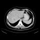 Focal nodular hyperplasia: CT - Computed tomography