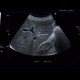 Focal nodular hyperplasia, FNH: US - Ultrasound