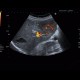 Focal nodular hyperplasia, FNH: US - Ultrasound