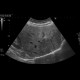 Focal nodular hyperplasia: US - Ultrasound