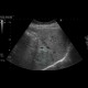 Focal nodular hyperplasia: US - Ultrasound