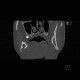 Follicular cyst, adamantinoma: CT - Computed tomography