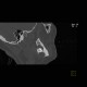 Follicular cyst, adamantinoma: CT - Computed tomography