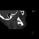Follicular cyst, adamantinoma: CT - Computed tomography