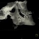 Follicular cyst, adamantinoma, VRT: CT - Computed tomography