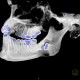 Follicular cyst, adamantinoma, VRT: CT - Computed tomography