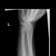 Fracture of scaphoid bone, dislocation of pisiform bone, abruption of lunate: X-ray - Plain radiograph