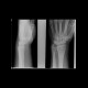 Fracture of scaphoid bone, dislocation of pisiform bone, abruption of lunate: X-ray - Plain radiograph