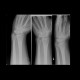 Fracture of scaphoid bone, dislocation of pisiform bone, abruption of lunate: X-ray - Plain radiograph