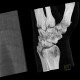 Fracture of scaphoid bone, dislocation of pisiform bone, abruption of lunate: CT - Computed tomography