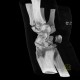 Fracture of scaphoid bone, dislocation of pisiform bone, abruption of lunate: CT - Computed tomography