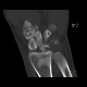 Fracture of scaphoid bone, dislocation of pisiform bone, abruption of lunate: CT - Computed tomography