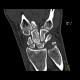 Fracture of scaphoid bone, dislocation of pisiform bone, abruption of lunate: CT - Computed tomography