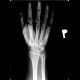 Fracture of scaphoid bone: X-ray - Plain radiograph