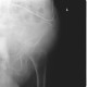 Comminuted fracture of acetabulum and pubic bone, central dislocation of femoral head: X-ray - Plain radiograph