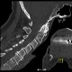 Fracture of dens axis: CT - Computed tomography