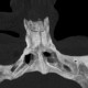 Fracture of nasal bones: CT - Computed tomography