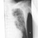 Rib fracture, lung contusion, hematoma, pneumothorax, hydropneumothorax: X-ray - Plain radiograph