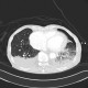 Rib fracture, lung contusion, hematoma, pneumothorax, hydropneumothorax: CT - Computed tomography