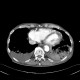 Rib fracture, lung contusion, hematoma, pneumothorax, hydropneumothorax: CT - Computed tomography