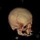 Depression fracture of the skull: CT - Computed tomography