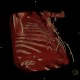 Rib fractures after resuscitation: CT - Computed tomography