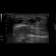 Facial lymphangioma: US - Ultrasound