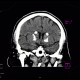 Fahr's disease, morbus Fahr: CT - Computed tomography