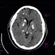 Fahr's disease, morbus Fahr: CT - Computed tomography
