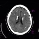 Fahr's disease, morbus Fahr: CT - Computed tomography