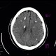 Fahr's disease, morbus Fahr: CT - Computed tomography