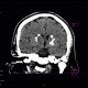 Fahr's disease, morbus Fahr: CT - Computed tomography