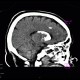 Fahr's disease, morbus Fahr: CT - Computed tomography