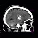 Fahr's disease, morbus Fahr: CT - Computed tomography