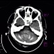 Fahr's disease, morbus Fahr: CT - Computed tomography