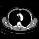 Fatty degeneration of subscapular muscle: CT - Computed tomography