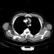 Fatty degeneration of subscapular muscle: CT - Computed tomography