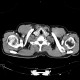 Fatty degeneration of subscapular muscle: CT - Computed tomography