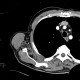 Fatty degeneration of subscapular muscle: CT - Computed tomography