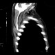 Fatty degeneration of subscapular muscle: CT - Computed tomography