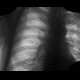 Fenestration of rib: X-ray - Plain radiograph