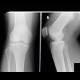 Fibrocartilaginous exostosis: X-ray - Plain radiograph