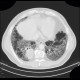 Lung fibrosis, decompensation after lobectomy: CT - Computed tomography