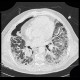 Lung fibrosis, decompensation after lobectomy: CT - Computed tomography